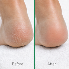 Solevee Glide in use on heel
